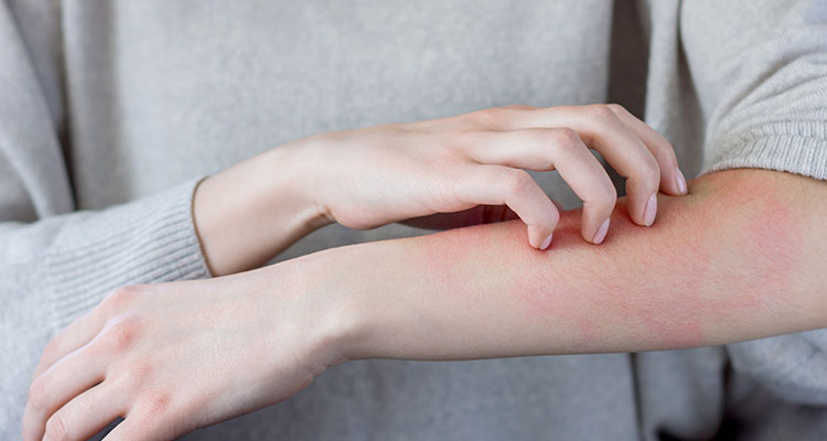 Contact Dermatitis or Eczema