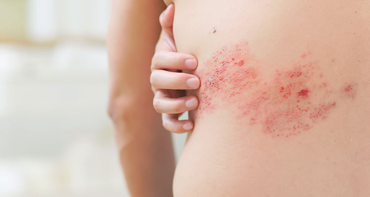 Herpes Zoster