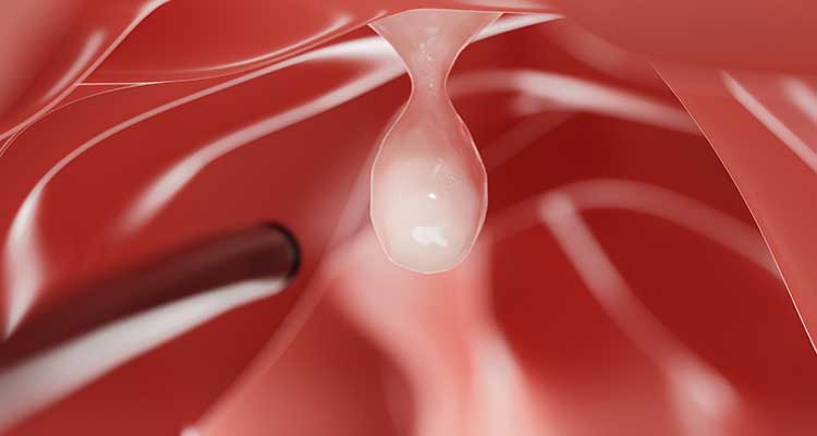 Pólipos Intestinais