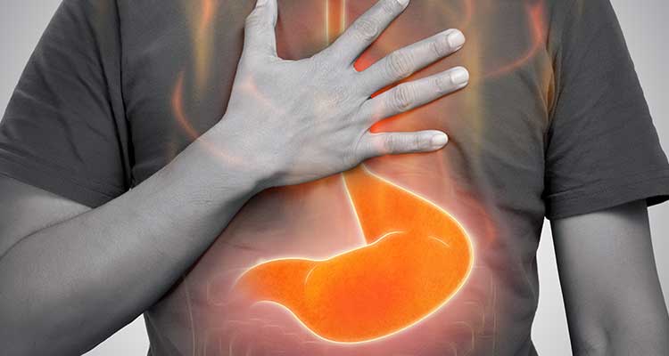 Refluxo Gastroesofágico