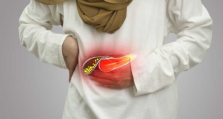 Litíase da Vesícula Biliar