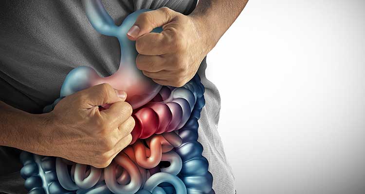 Doença Inflamatória do Intestino