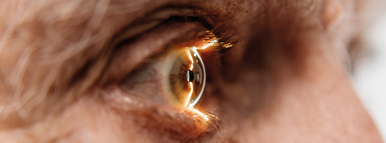 Glaucoma