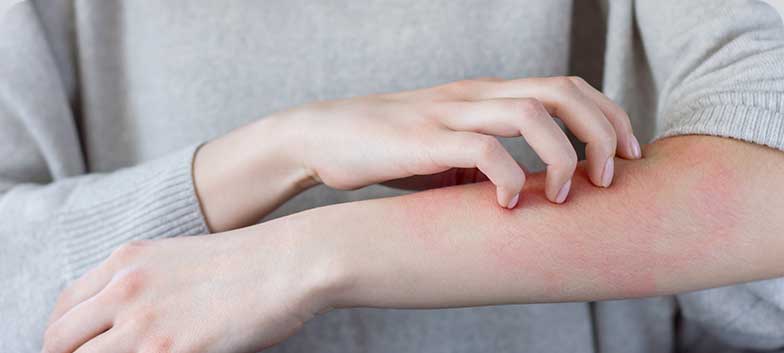 Dermatite ou Eczema de Contato