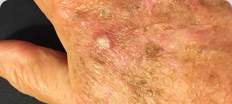 Actinic Keratosis