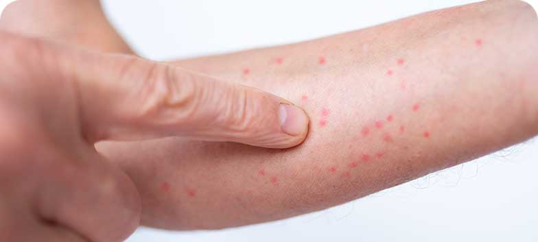 Escabiose ou Sarna Vulgar