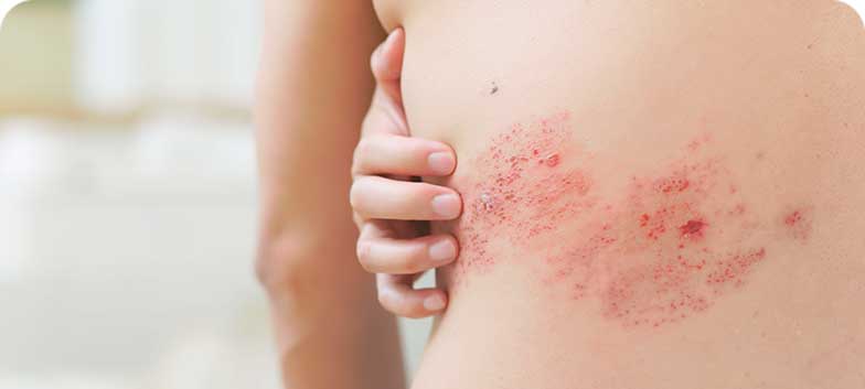 Herpes Zóster
