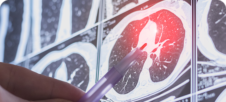 Cancro do pulmão