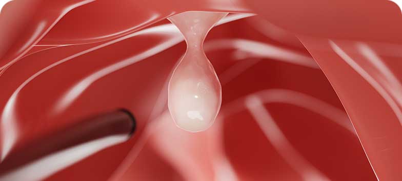 Pólipos Intestinais