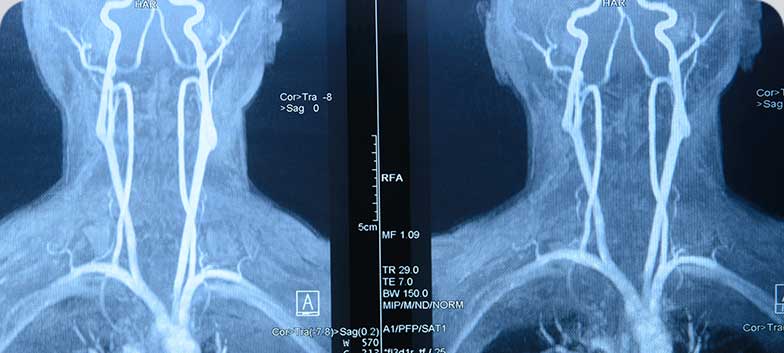 Carotid artery stenosis